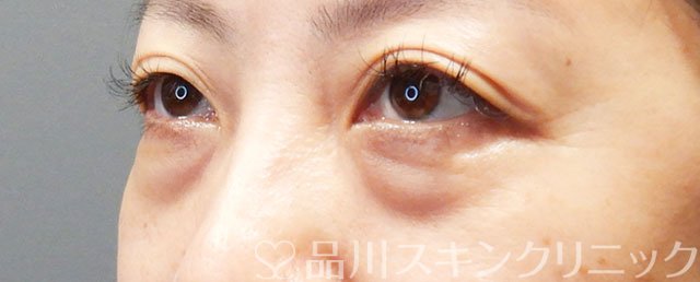 症例NO.72694のBEFORE写真