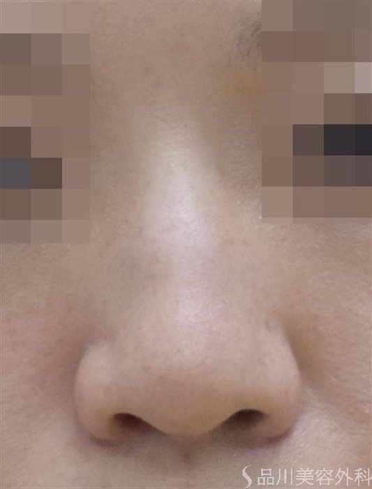 症例NO.51781のAFTER写真