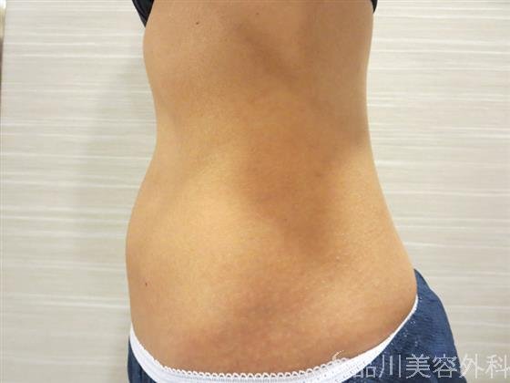 症例NO.20556のAFTER写真