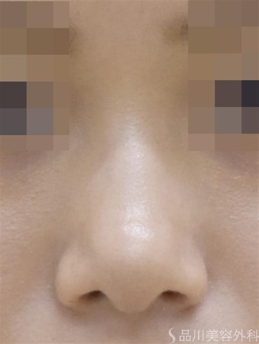 症例NO.47156のAFTER写真
