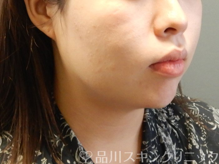 症例NO.62168のAFTER写真