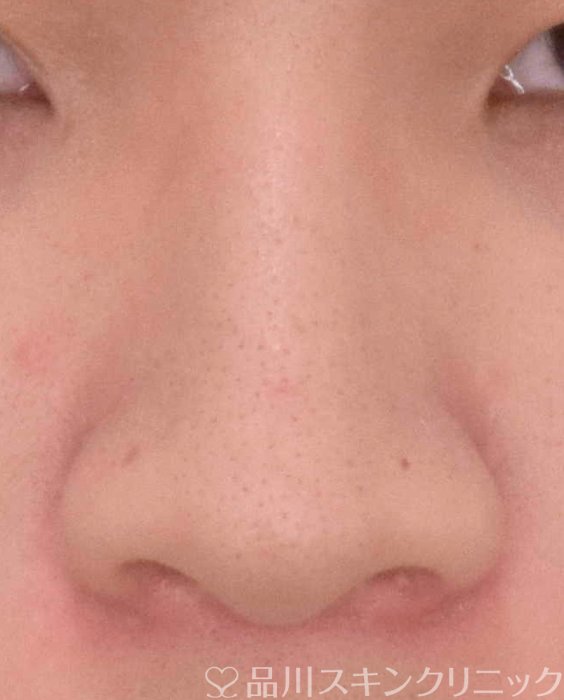 症例NO.66869のBEFORE写真