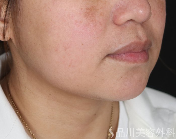 症例NO.73454のBEFORE写真