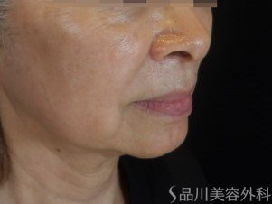 症例NO.74538のBEFORE写真