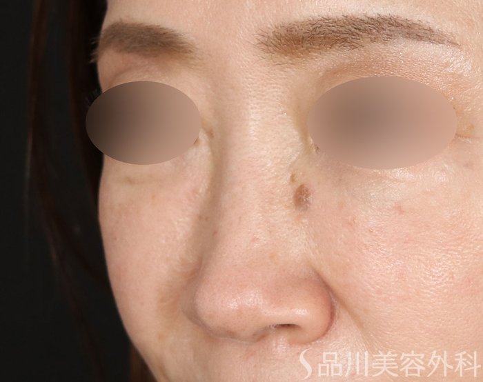 症例NO.72659のBEFORE写真