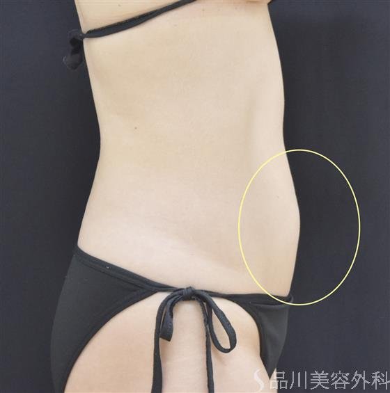 症例NO.50003のBEFORE写真