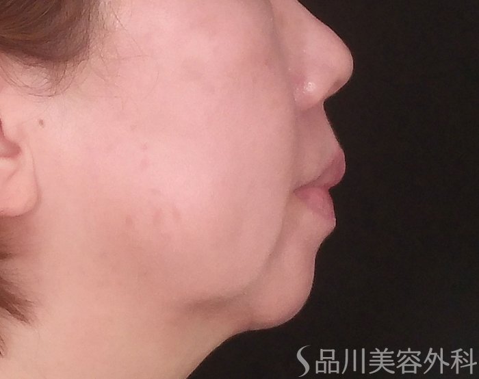 症例NO.70597のBEFORE写真