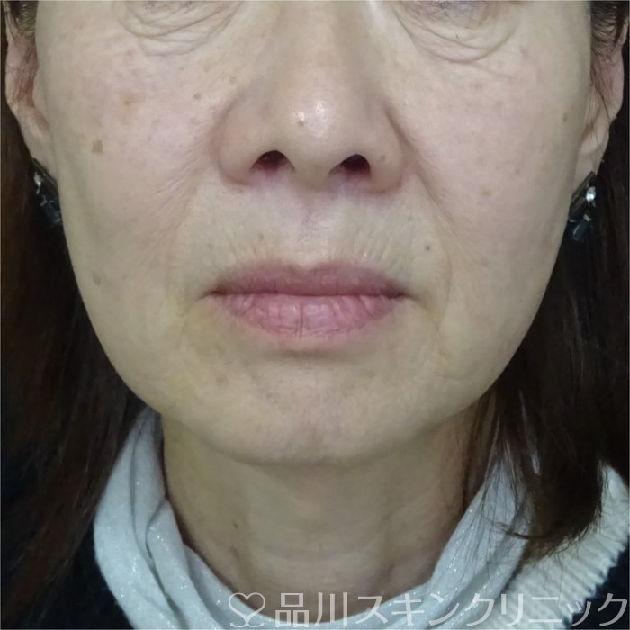 症例NO.73340のBEFORE写真