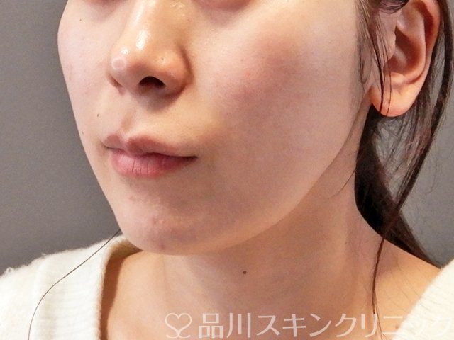 症例NO.64028のBEFORE写真