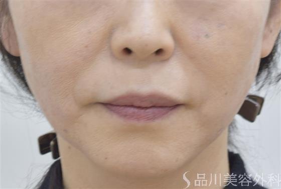 症例NO.46600のAFTER写真