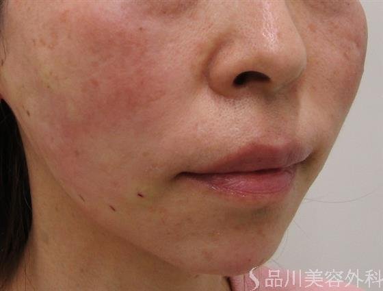 症例NO.43619のAFTER写真