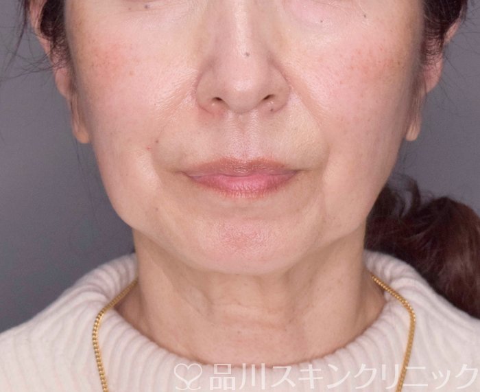 症例NO.70197のBEFORE写真