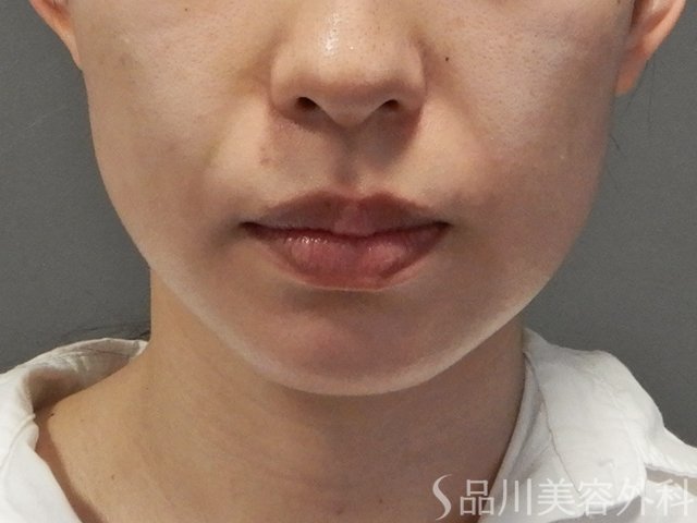 症例NO.74654のBEFORE写真