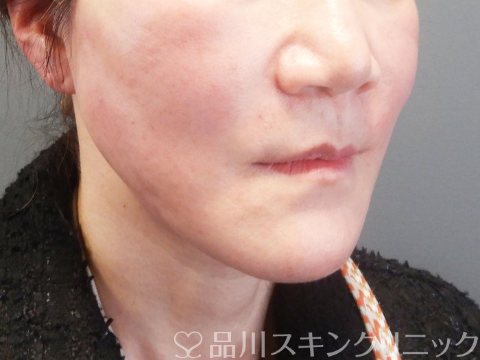 症例NO.73576のAFTER写真