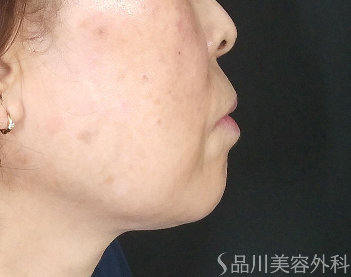 症例NO.69313のBEFORE写真