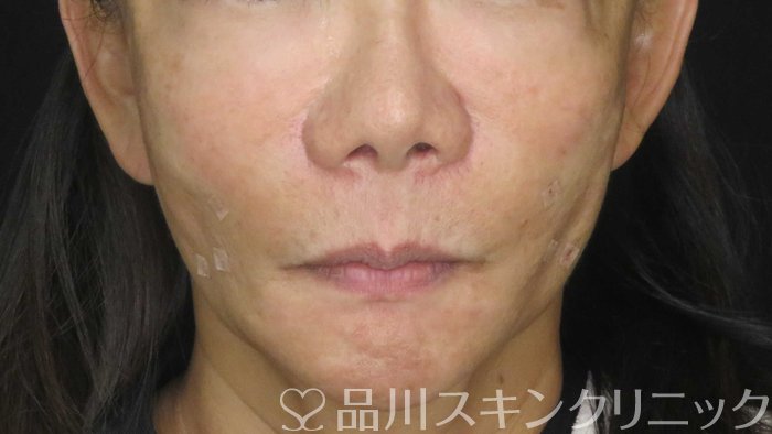 症例NO.71467のAFTER写真
