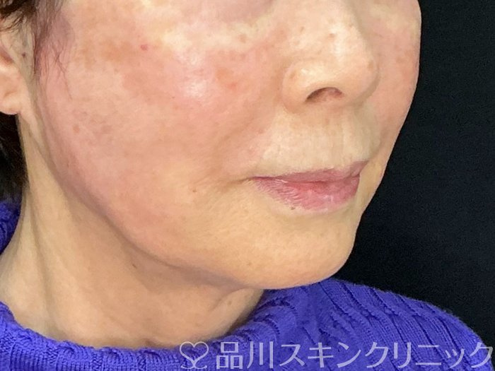 症例NO.73212のAFTER写真