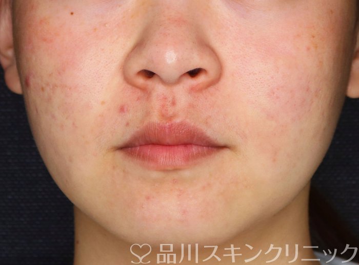 症例NO.64067のAFTER写真