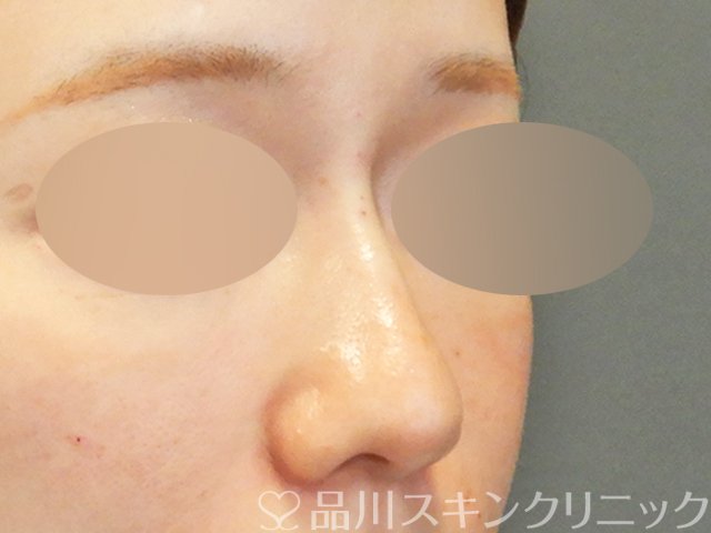 症例NO.67901のAFTER写真