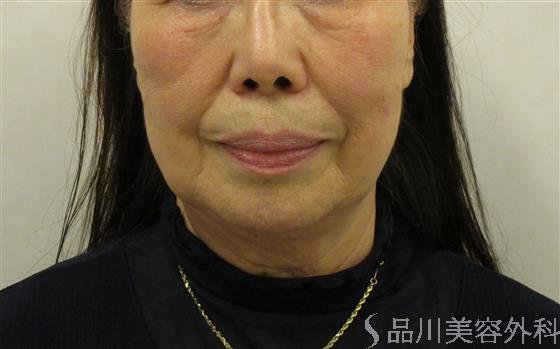 症例NO.58238のBEFORE写真