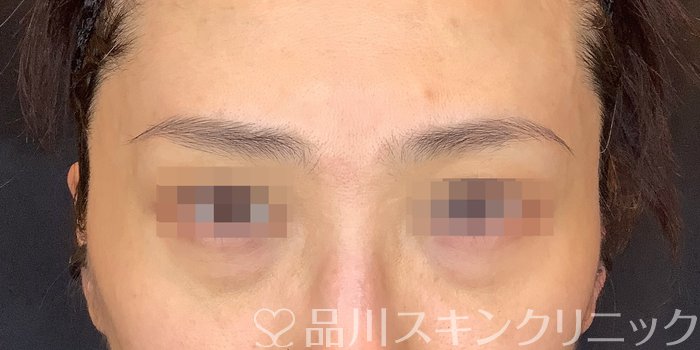 症例NO.68735のBEFORE写真