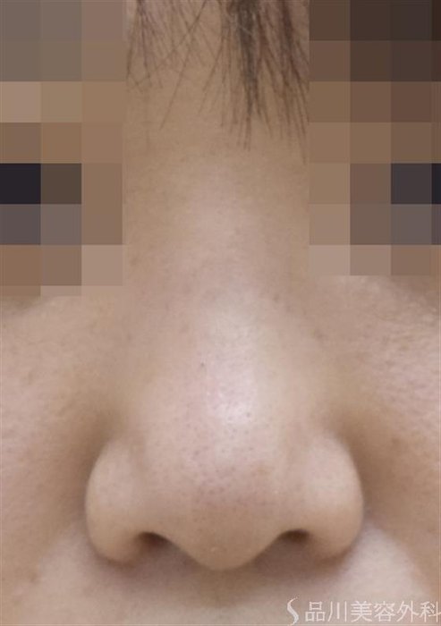 症例NO.50692のAFTER写真