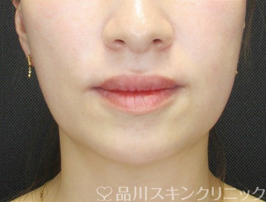 症例NO.70355のBEFORE写真