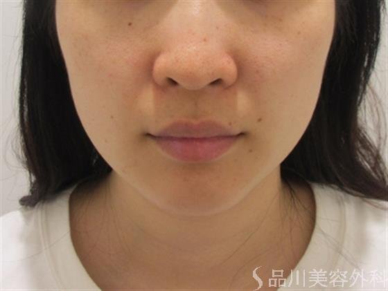 症例NO.24565のBEFORE写真
