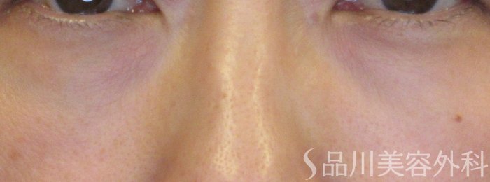 症例NO.75083のAFTER写真