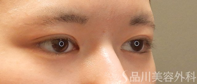 症例NO.73254のBEFORE写真