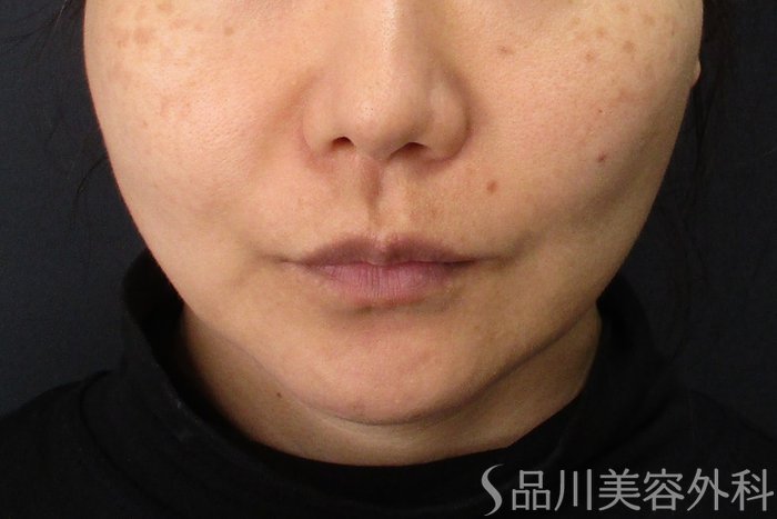 症例NO.71595のAFTER写真