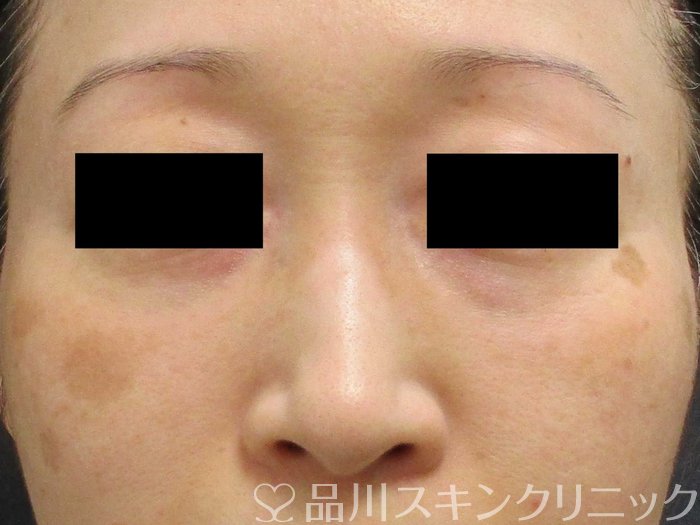 症例NO.64932のBEFORE写真