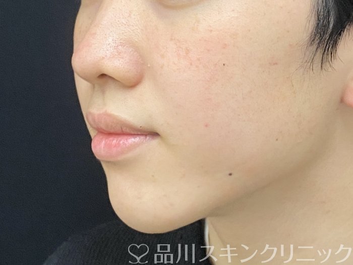 症例NO.73946のAFTER写真