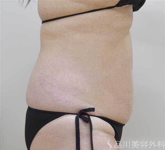 症例NO.45927のAFTER写真