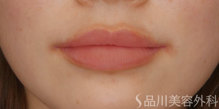 症例NO.69243のAFTER写真
