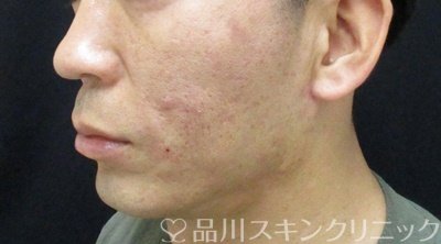 症例NO.70654のAFTER写真