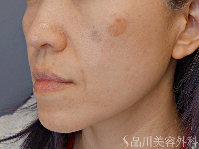 症例NO.74211のBEFORE写真
