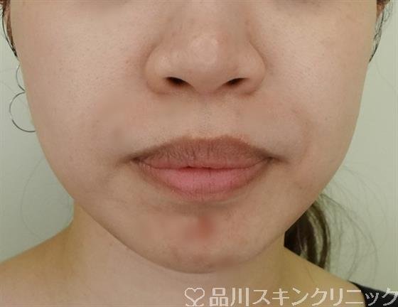 症例NO.48484のAFTER写真