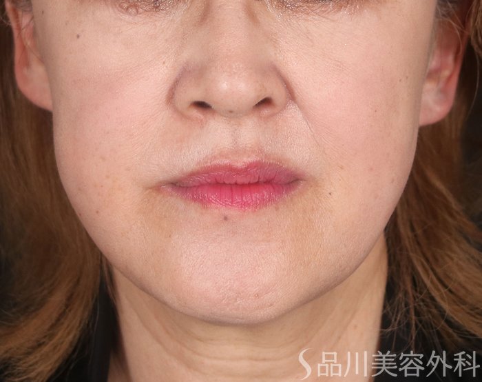 症例NO.73497のAFTER写真