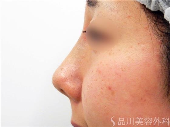 症例NO.56381のAFTER写真