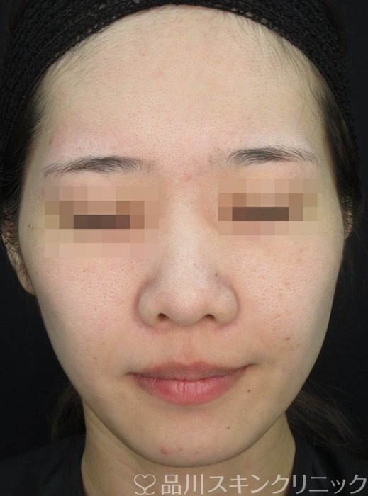 症例NO.72243のBEFORE写真