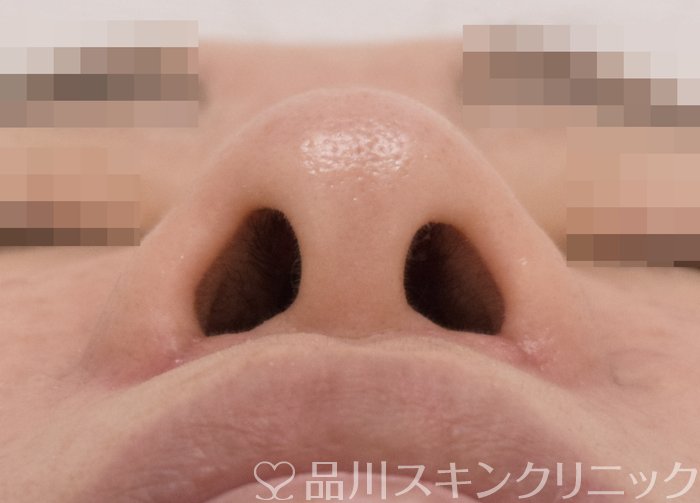 症例NO.73335のAFTER写真