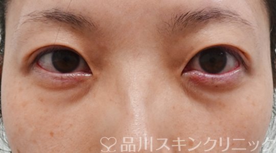 症例NO.70672のBEFORE写真