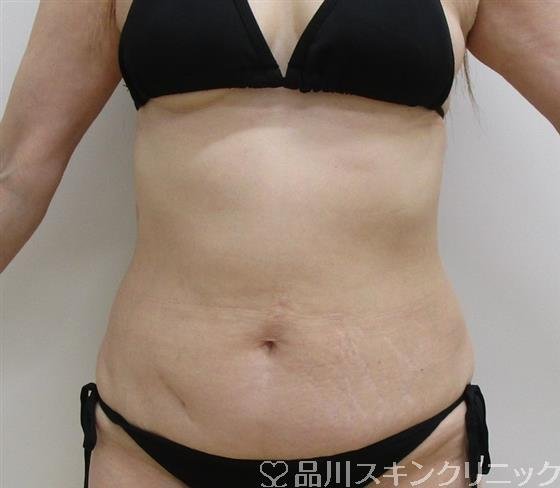症例NO.35871のAFTER写真