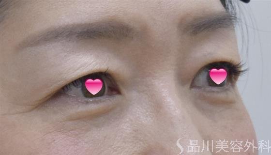症例NO.52440のAFTER写真