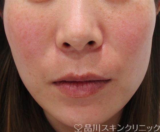 症例NO.33339のBEFORE写真
