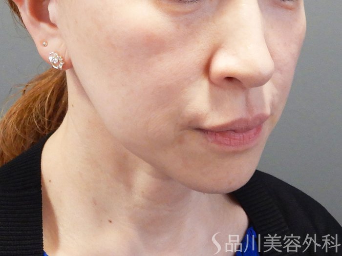 症例NO.74626のBEFORE写真