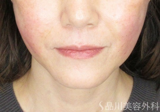症例NO.71255のAFTER写真