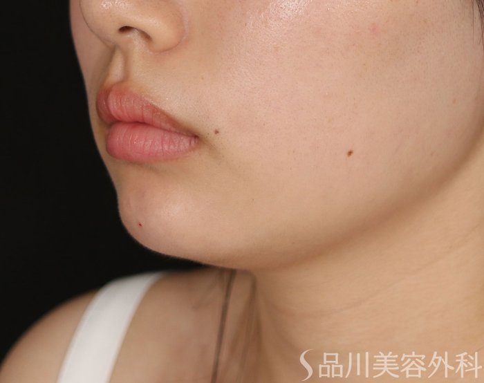 症例NO.71127のAFTER写真