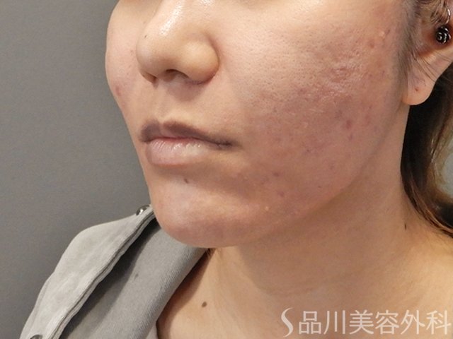 症例NO.74604のAFTER写真
